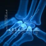 Bone Density Quiz