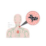 Lymphatic System Disorders